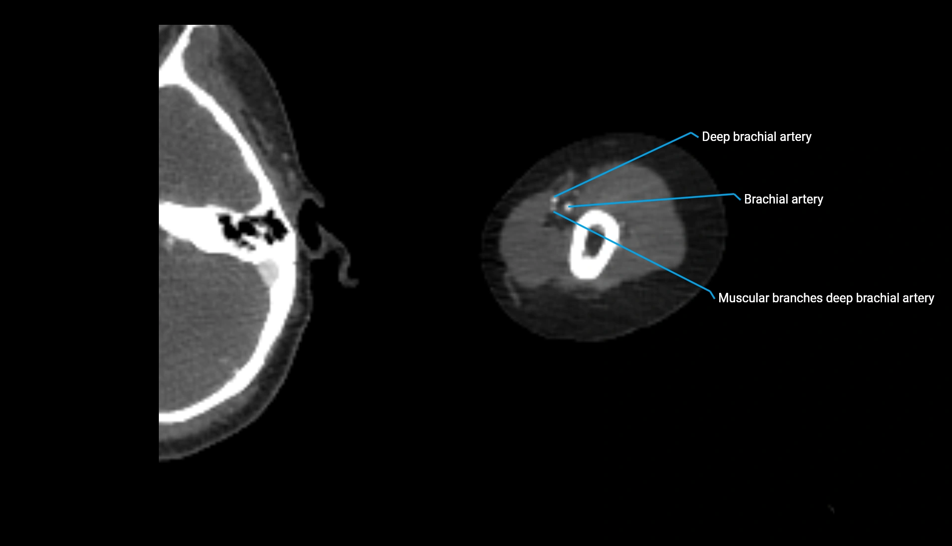 CTA upper limb axial cross sectional anatomy labelled image 259 (2).webp